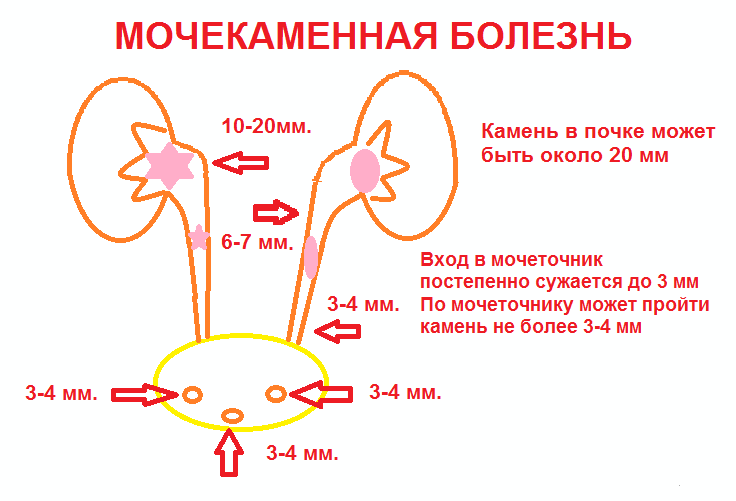 Мочекаменная болезнь