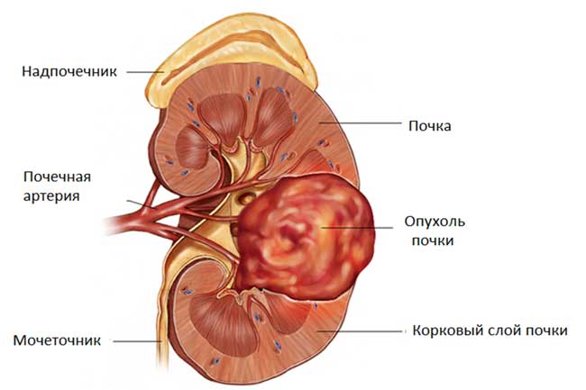 Онкология почек