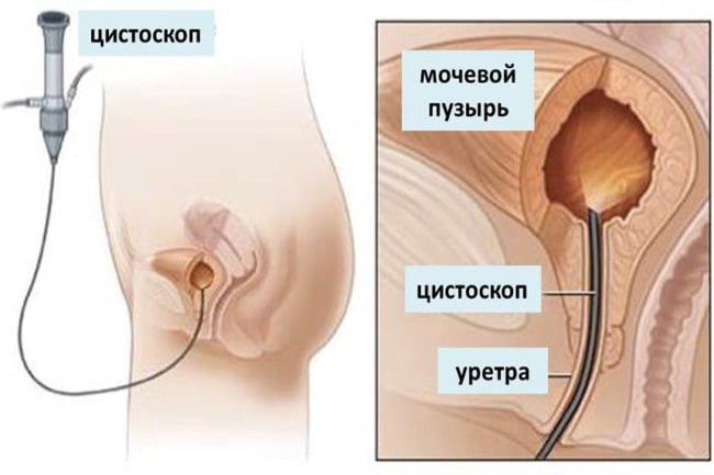 Дифференциальная диагностика мочевого пузыря