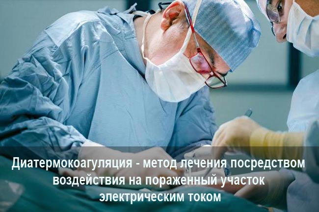 Диатермокоагуляция