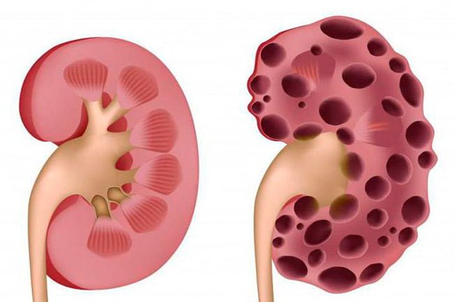 Симптомы и лечение поликистоза почек