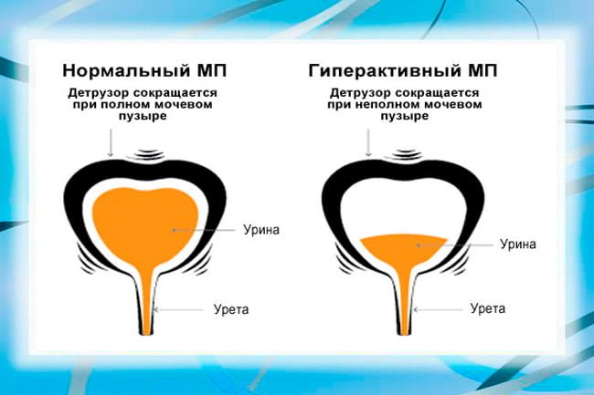 Гиперактивный мочевой пузырь