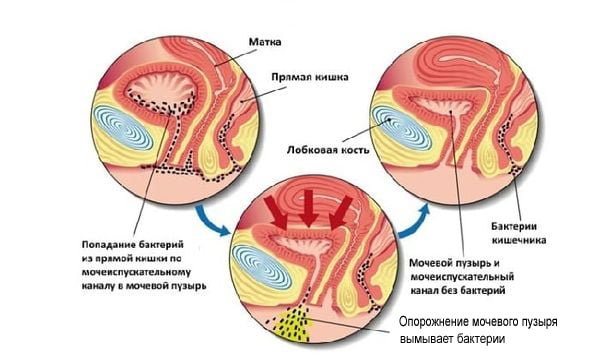 Цистит как причина частого мочеиспускания перед месячными