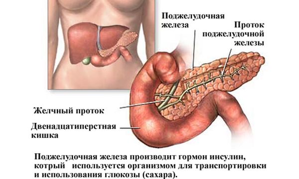 Схема развития сахарного диабета у женщины