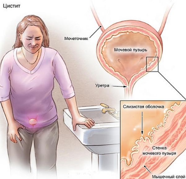 Цистит во время и после месячных