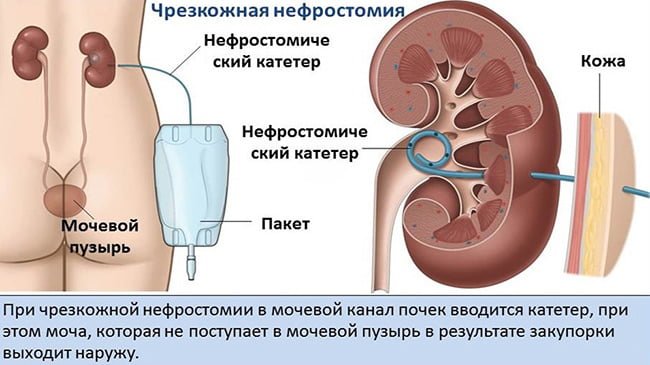 Чрезкожная нефростомия