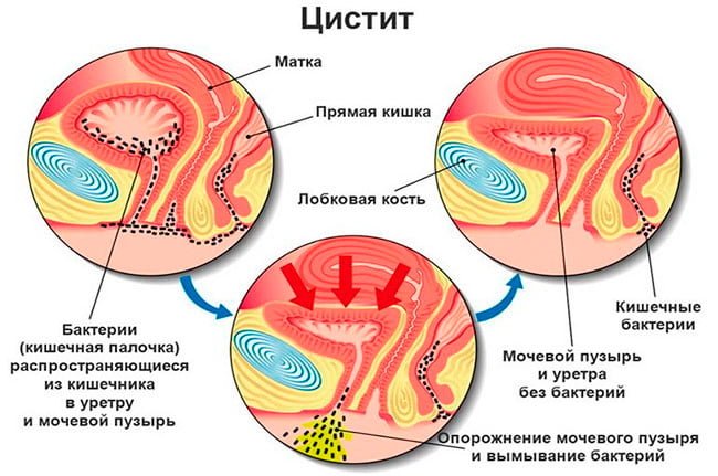 Цистит