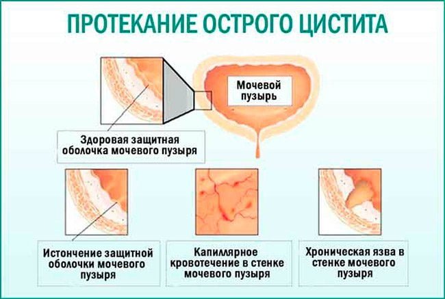 Острый цистит