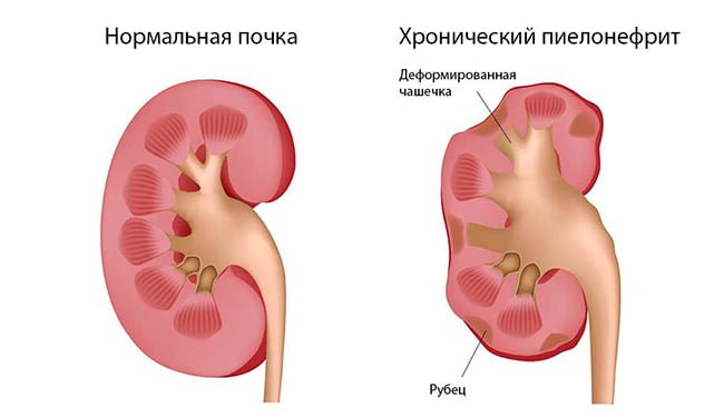 Пиелонефрит почки