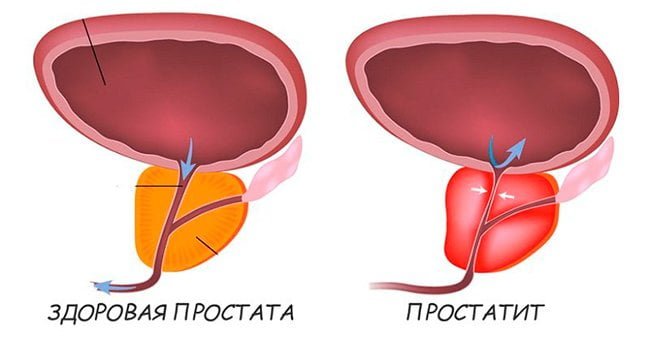 Простатит