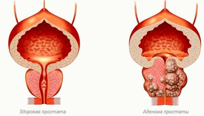 Аденома предстательной железы