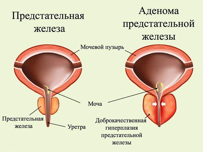 Аденома простаты 