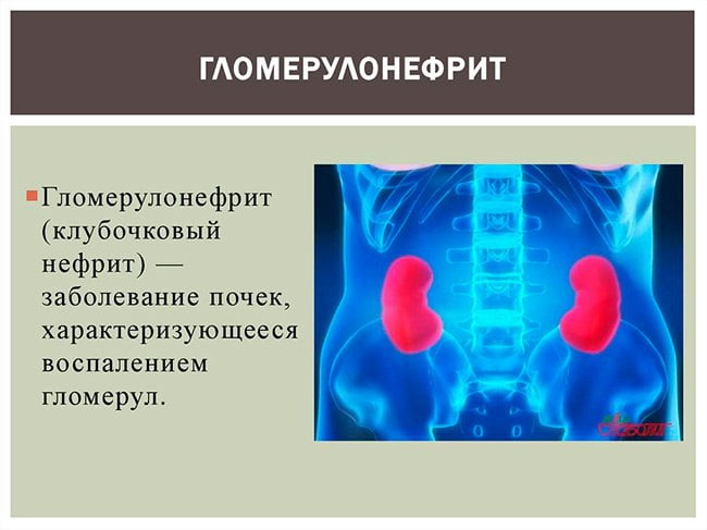 Что такое гломерулонефрит