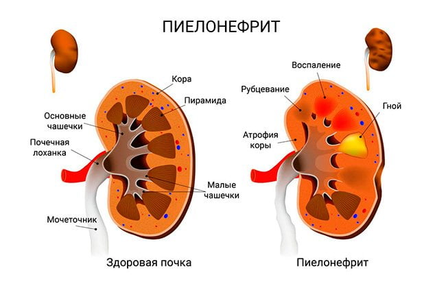 Пиелонефрит почки