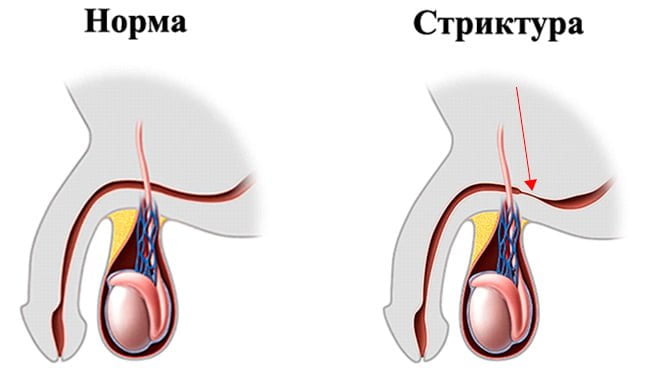 Стриктура уретры