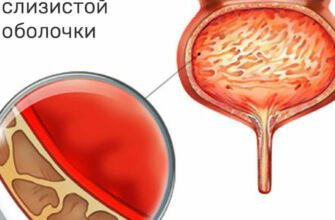 Лечение воспаления мочевого канала у женщин: эффективные методы и рекомендации