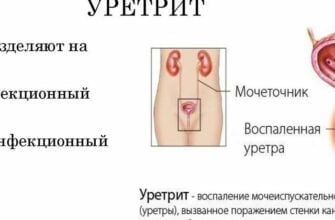 Воспаление мочевого канала у женщин: симптомы, лечение, причины